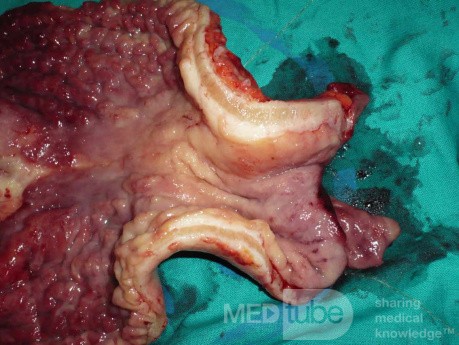 Endoscopy of Scirrhous Gastric Carcinoma involving the entire Fundus, Body and the Antrum (33 of 47)