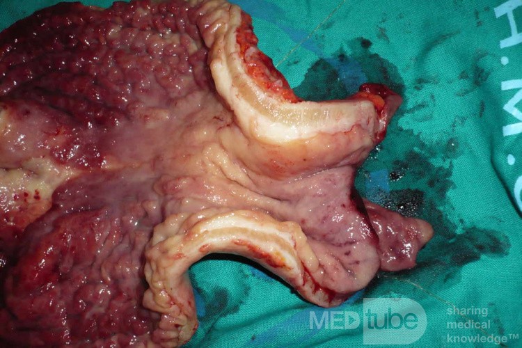 Endoscopy of Scirrhous Gastric Carcinoma involving the entire Fundus, Body and the Antrum (33 of 47)
