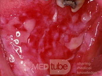 Lichen planus [major erosive]