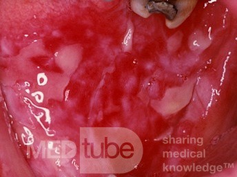 Lichen planus [major erosive]