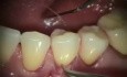 best way to cover gingival recession