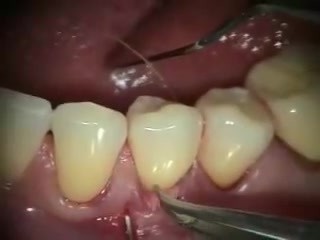 best way to cover gingival recession