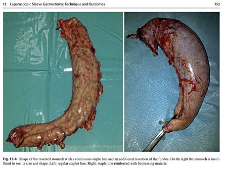 Bariatric Surgery 2020