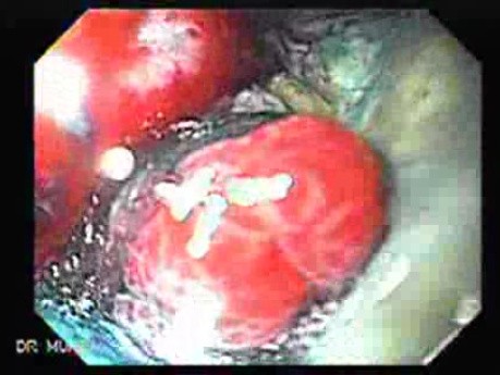 Multiple Irregular and Large Ulcers - Biopsy nr 1