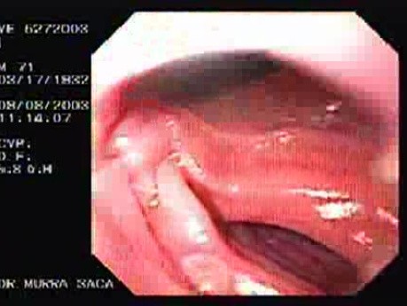 Esophago-Jejunostomy Roux-en-Y (1 of 6)