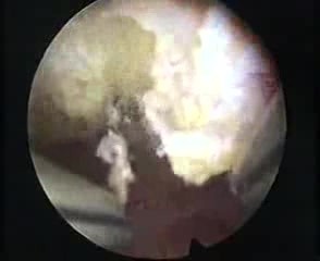 New Resection Master Systeme And Endometrial Polyp