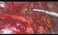 Laparoscopic Management Of Colocutaneous, Colovaginal Fistula Due to Complicated Sigmoid Diverticular Disease