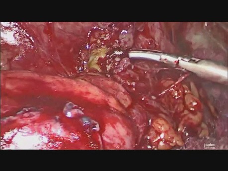 Laparoscopic Management Of Colocutaneous, Colovaginal Fistula Due to Complicated Sigmoid Diverticular Disease