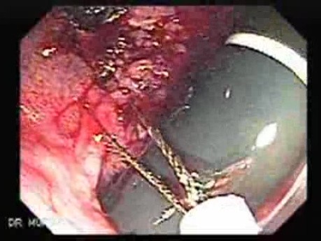 Endoscopic Resection of Giant Tubulo-Villous of the rectum (17 of 35)