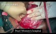 Cesarean Hysterectomy Placenta Previa, Acreta, Percreta