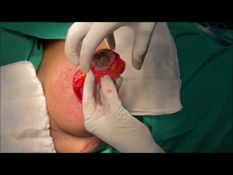 Grissoti Flap Mammoplasty in Centrally Located Breast Cancer