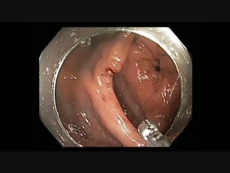 Colonoscopy - Ascending Colon EMR Scar