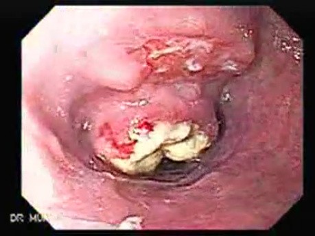 Small cell carcinoma of the lung that invades the upper and the middle third of the Esophagus (1 of 7)