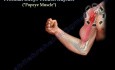 Proximal Biceps Tendon Rupture - Video Lecture