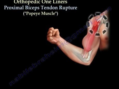 Proximal Biceps Tendon Rupture - Video Lecture