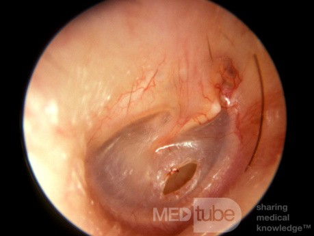 Myringotomy Incision
