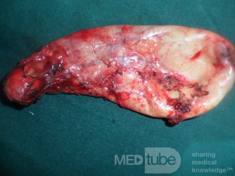 Acute cholecystitis removed by Lap chole