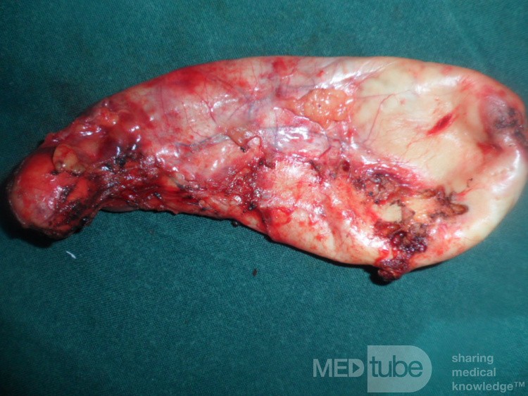 Acute cholecystitis removed by Lap chole