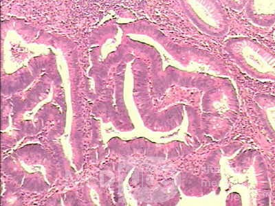Malign Polyp (5 of 8)