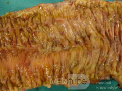 Toxic Dilatation of the Colon Superimposed pseudomembranous colitis involving the
 right colon (16 of 17)