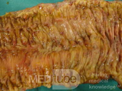 Toxic Dilatation of the Colon Superimposed pseudomembranous colitis involving the
 right colon (16 of 17)