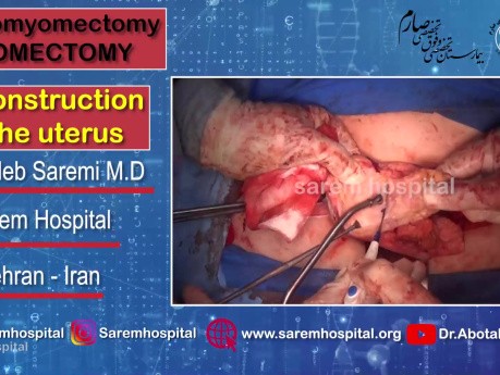 Adenomyomectomy