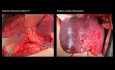 Posterior Right Sectionectomy with Resection of the Right Hepatic Vein, for Colon Cancer Metastasis - Case Presentation