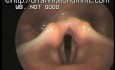 Acute Laryngitis - Voice Box