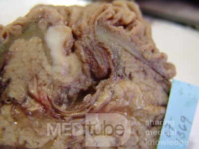 Cholangiocarcinoma that infiltrated a Periampullary Duodenal Diverticula and the head of the pancreas (10 of 20)