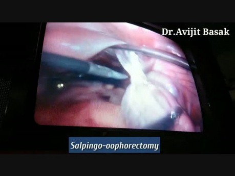 Laparoscopic Surgery for Torsion with Dense Adhesion Ovarian Cyst