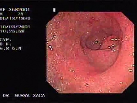 Erosive Antral Gastritis