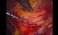 Laparoscopic Bilateral Inguinal TEP Mesh Hernioplasty