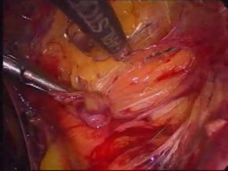 Laparoscopic Bilateral Inguinal TEP Mesh Hernioplasty