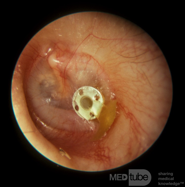 Mucoid Otitis Media Draining from VentilationTube