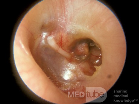Cholesterol Granuloma Middle Ear