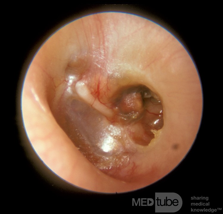 Cholesterol Granuloma Middle Ear