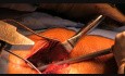 Minimally Invasive Anterior Hip Replacement (Huerter-Judet type) by Dr Marc Fischer
