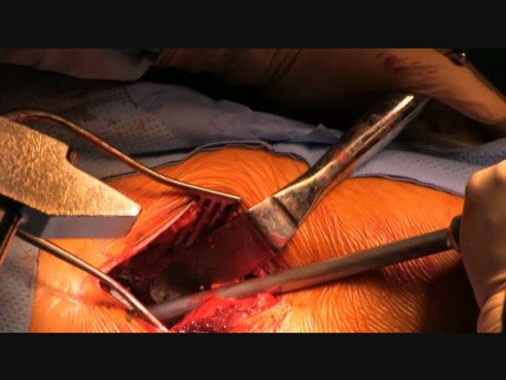 Minimally Invasive Anterior Hip Replacement (Huerter-Judet type) by Dr Marc Fischer