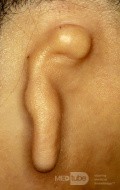 Microtia of the Ear [right]