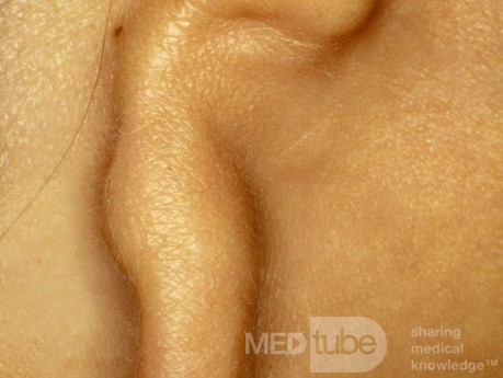Microtia of the Ear [right]