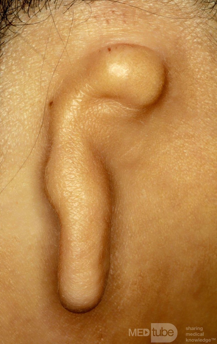 Microtia of the Ear [right]