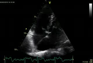 Tri-Atrial Heart
