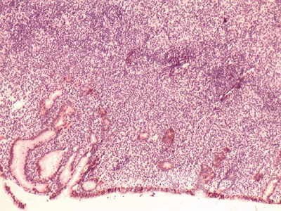 Gastric Lymphoma (6 of 10)
