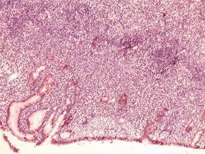 Gastric Lymphoma (6 of 10)
