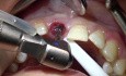 Immediate Implants with Immediate Provisionals Dreams and Reality! EAO Congress, Vienna 2018