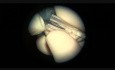 An Artificial Calcificated Lens Removal, Without Intact the Capsula 5 Years After it's Implantation