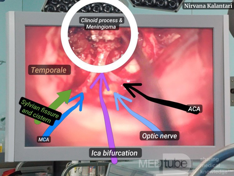 Medial Clinoidal Meningioma
