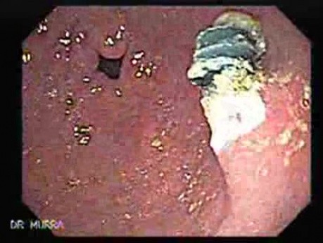 Hyperplastic Polyps - Endoscopy (13 of 14)