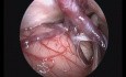 Endoscopic Assisted MVD