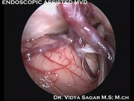 Endoscopic Assisted MVD